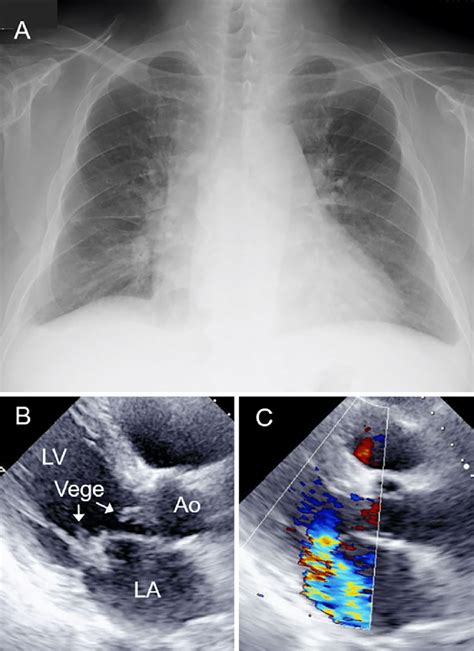 Figure1chest X Ray A And A Transthoracic Parasternal Long Axis