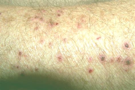 Morgellons Disease Pictures Symptoms Treatment Causes