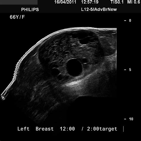 Target Ultrasound Image Of The Left Breast Upper Outer Quadrant Shows A