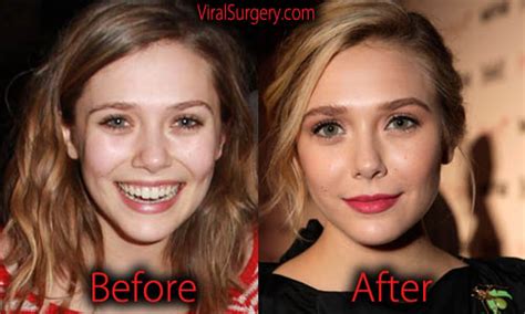 Elizabeth Olsen Plastic Surgery Before And After Nose Job Botox Pictures