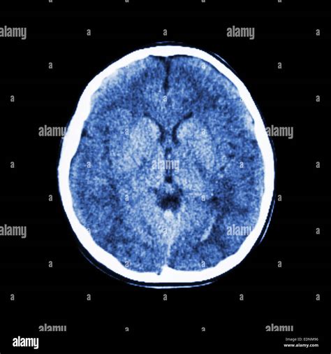 Normal Ct Scan Of Brain Computed Tomography Stock Photo Alamy