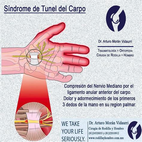 Síndrome De Túnel Del Carpo Dr Arturo Moran Vidaurri