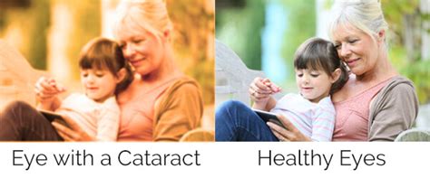 The doctor cuts a very thin flap on the eye and folds back. Cataracts Sarasota | Cataract Surgery Venice | Cataract ...