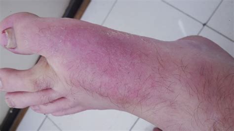 Red Skin Condition On Foot Pic Included Thread Discussing Red Skin