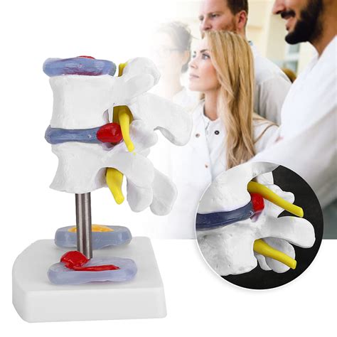 Buy Medical Human Size Model Anatomical Lumbar Disc Herniation