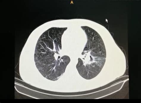 Destacable la buena respuesta terapéutica de pulmonares efectuadas después de completar la. José Pereira Brunelli on Twitter: "Mucormicosis pulmonar ...