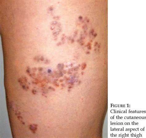 Figure 1 From Congenital Multiple Clustered Dermatofibroma And Multiple Eruptive Dermatofibromas