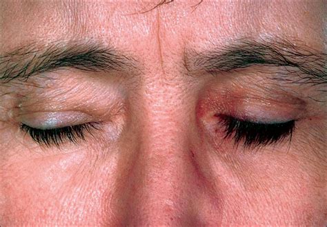 Periocular Cutaneous Pigmentary Changes Associated With Bimatoprost Use