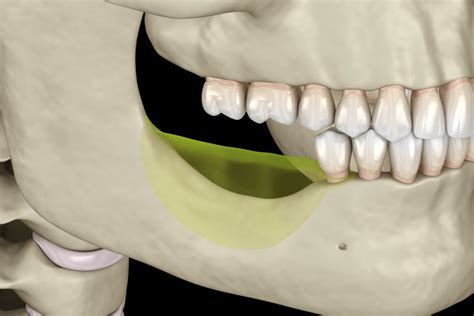 The Importance Of Bone Grafting In Dental Implant Treatment Anderson