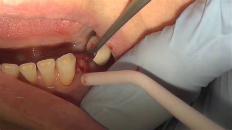 How To Pull A Broken Tooth Youtube