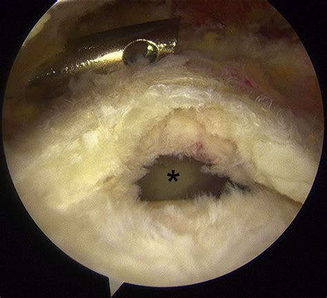 Full Thickness Rotator Cuff Tear In The Same Patient As Viewed From