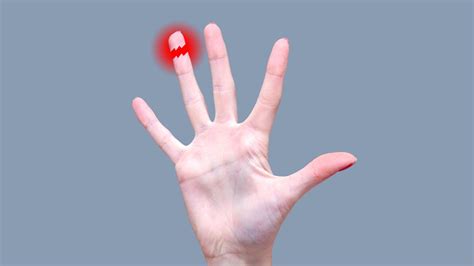 The Case Of The Lost Fingertip Medpage Today