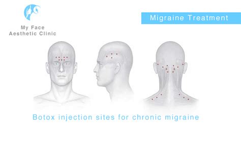 Botox Injection Sites For Migraines Diagram Drivenheisenberg
