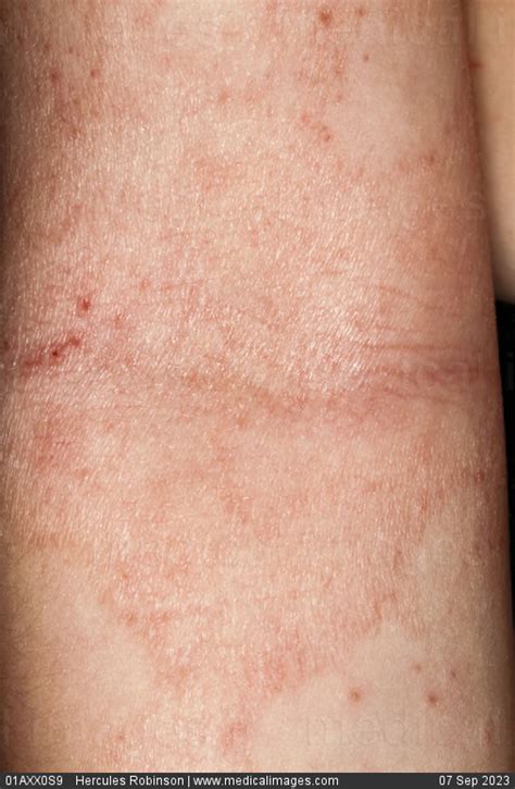 Stock Image Dermatology Atopic Eczema Inflamed Dry Pink Excoriated