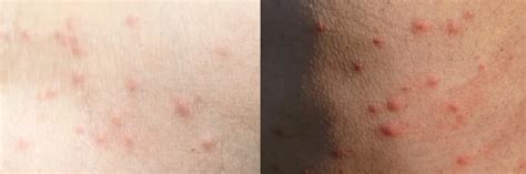 Flea Bite Vs Bed Bug Bite How Tell Them Apart Solutions Pest And Lawn