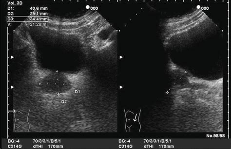 Prostate And Seminal Vesicles Ultrasound Anatomy And Scanning Methods