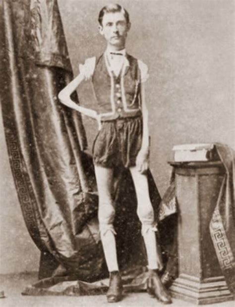 Famous Freak Show Acts And Their Stories Of Exploitation And Tragedy