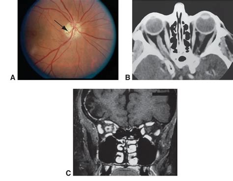 Optic Nerve Sheath Meningioma American Academy Of Ophthalmology