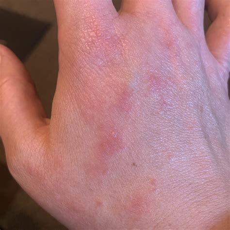 Hoping For Help Identifying This Rash On My Hand It Itches Unless I