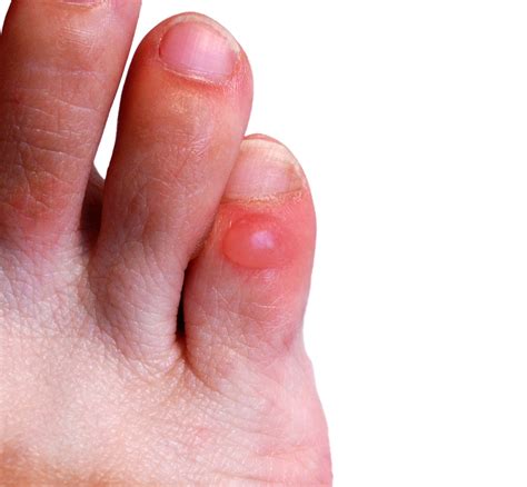 Blisters Foot First Podiatry