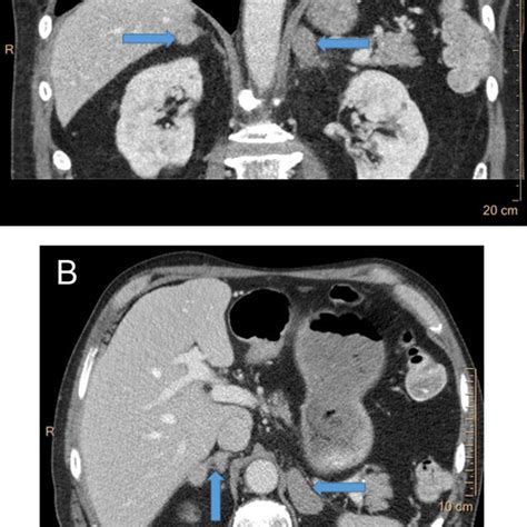 Contrast Enhanced Computed Tomography Ct Of The Adrenals In Patient 2