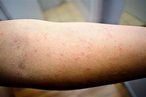 Scabies Pictures