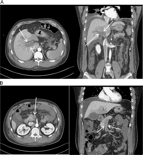 The Initial Abdominal Computed Tomography Ct Selected Axial And