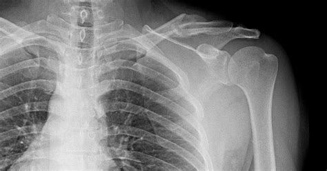 Rehab For A Broken Collarbone After Surgery Livestrongcom
