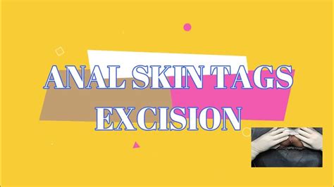 Anal Skin Tags Excision Youtube