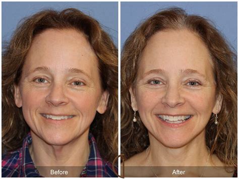 Facelift After Weight Loss Before And Afters From Dr Sadati