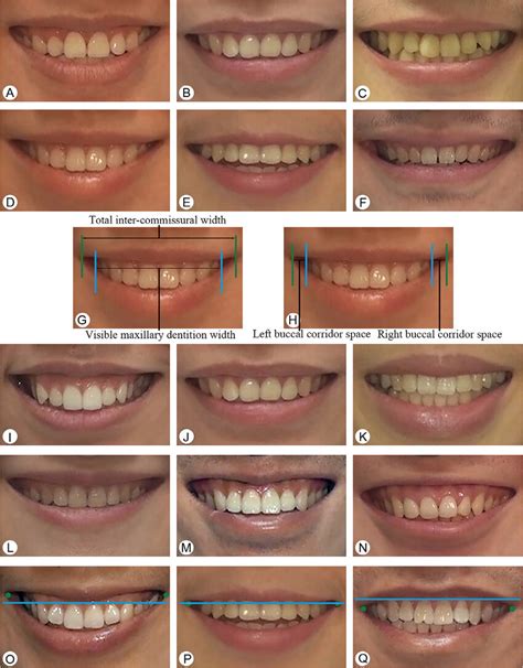 Examples Of Smile Variables Collected From Left To Right A B C