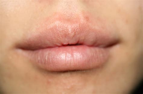 Discoloration On Lips Pictures