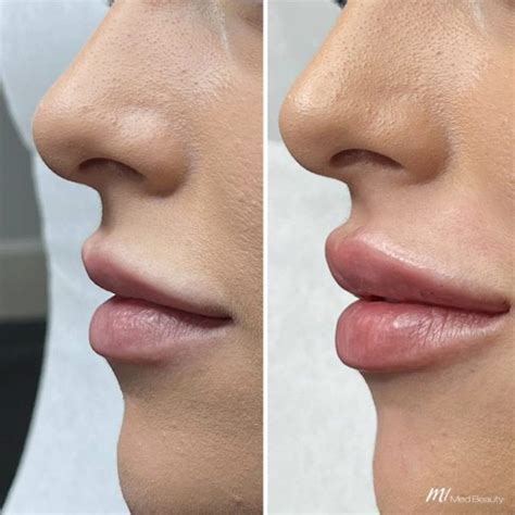 Lip Fillers Starting From £ 99 M1 Med Beauty London Liverpool