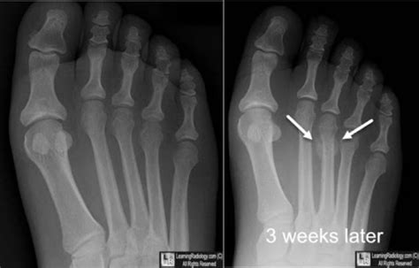 Stress Fractures Yakima Foot And Ankle