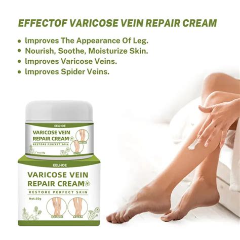 Vasculitis Ointment Relief Phlebitis Treatment Cream Varicose Veins