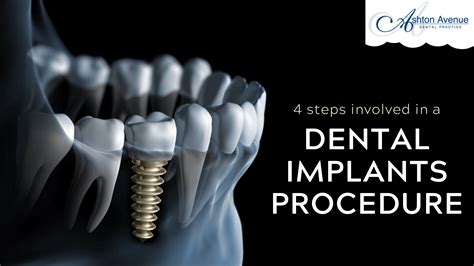 Dental Implant Procedure Step By Step Missing Teeth Replacement Claremont Dental Blog