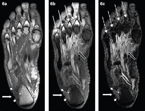 Foot Muscles Mri Soft Tissue Hemangioma The Alfred I Dupont