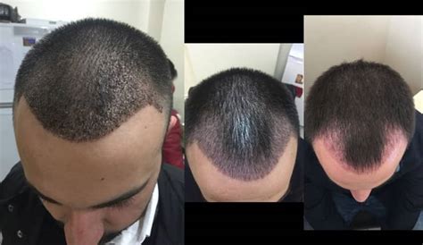 Payaslı kliniği olarak, saç dökülmesi yaşayan hastalara sağlıklı, doğal görünümlü, farkedilmeyen, kalıcı saç ekimi hizmetini fue tekniği ile sunuyoruz. Saç Ekimi Sonrası Sizi Neler Bekliyor? I Dr.Hakan DOĞANAY