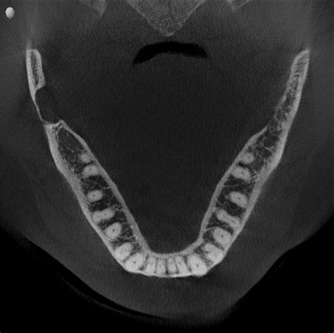 Diagnosis For Bc Oral Pathology Case No 44 Something To Sleep On