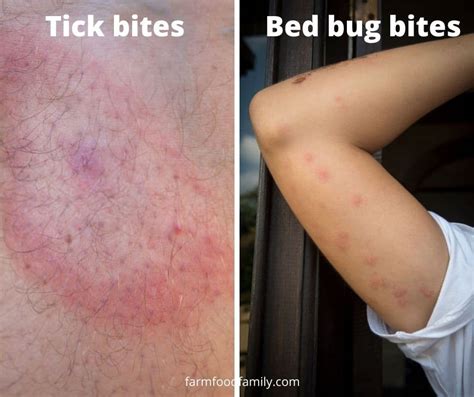 Bed Bugs Vs Ticks Side By Side Similarities And Differences Photos