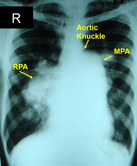 X Ray Chest Pa View In Severe Pulmonary Hypertension Pah All About