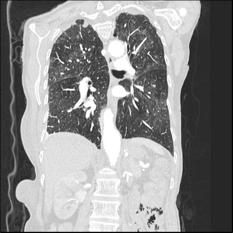 Pneumocystis Jiroveci Pneumonia Image
