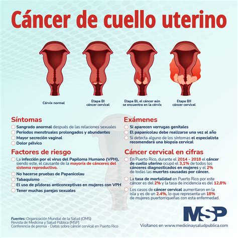 Cáncer De Cuello Uterino Infografía