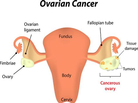 However, surgery, chemotherapy and radiotherapy for ovarian cancer can cause 'early menopause' in women who have not yet reached menopause. Early Symptoms Of Ovarian Cancer That You Must Be Aware Of ...