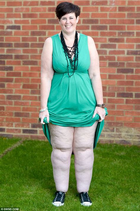 obese mother is left with tree trunk legs due to rare condition despite drastic weight loss