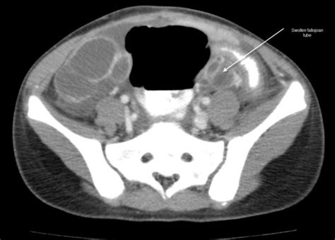 Ct Scan Of The Abdomen And Pelvis With Intravenous And Oral Contrast