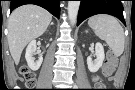 Small Pheochromocytoma Right Adrenal Gland Adrenal Case Studies