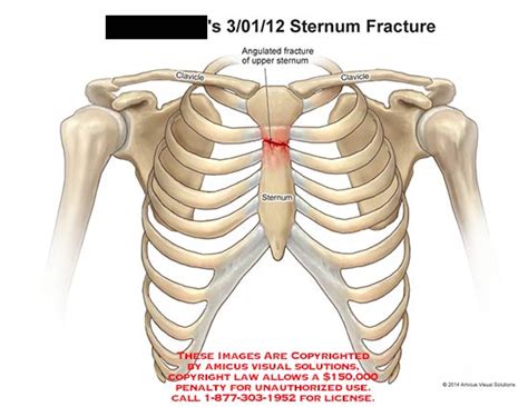 Sternum Fracture
