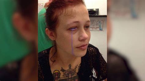 women with make up tattoos suffer horrific facial burns after going in for mri scans daily