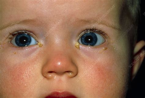 Close Up Of Babys Eyes With Acute Conjunctivitis Stock Image M155